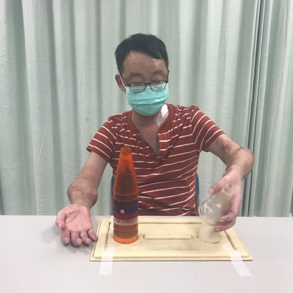 王致遠成功接受雙臂移植手術，成為台灣首例，正積極復健中。（王致遠提供）圖片