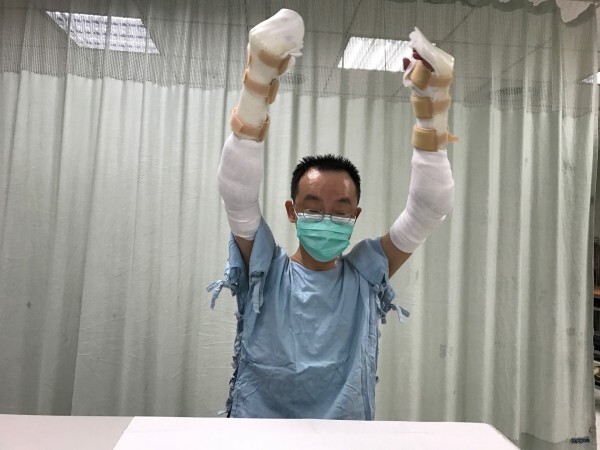王致遠成功接受雙臂移植手術，成為台灣首例，正積極復健中。（王致遠提供）圖片